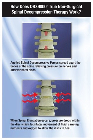 DRX9000 spinal decompression